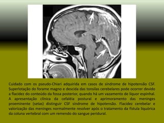 Cuidado com os pseudo-Chiari adquirida em casos de síndrome de hipotensão CSF.
Superlotação do forame magno e descida das tonsilas cerebelares pode ocorrer devido
a flacidez do conteúdo da fossa posterior, quando há um vazamento de líquor espinhal.
A apresentação clínica da cefaléia postural e aprimoramento das meninges
proeminente (setas) distinguir CSF síndrome de hipotensão. Flacidez cerebelar e
valorização das meninges normalmente resolver após o tratamento da fístula liquórica
da coluna vertebral com um remendo do sangue peridural.
 