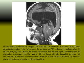 Muitos clássicos achados de imagem têm sido descritos em Chiari II, embora nem todas as
descobertas podem estar presentes. Os achados de RM incluem (1) colpocefalia; (2)
tectum bico, (3) uma cascata de vermis deslocadas inferiormente por trás da medula; (4)
alongado, ventrículo tube-like quarto; (5) de baixa altitude herophili torcular; (6)
hemisférios cerebelares envolvendo em torno do tronco cerebral anterior (7); côncava
clivus; (8) estimular medular; e (9) medular kink.
 