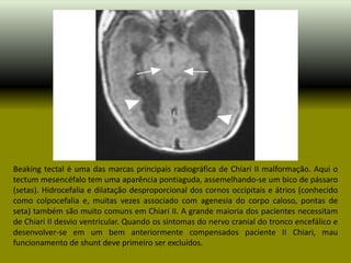 Beaking tectal é uma das marcas principais radiográfica de Chiari II malformação. Aqui o
tectum mesencéfalo tem uma aparência pontiaguda, assemelhando-se um bico de pássaro
(setas). Hidrocefalia e dilatação desproporcional dos cornos occipitais e átrios (conhecido
como colpocefalia e, muitas vezes associado com agenesia do corpo caloso, pontas de
seta) também são muito comuns em Chiari II. A grande maioria dos pacientes necessitam
de Chiari II desvio ventricular. Quando os sintomas do nervo cranial do tronco encefálico e
desenvolver-se em um bem anteriormente compensados ​paciente II Chiari, mau
funcionamento de shunt deve primeiro ser excluídos.
 