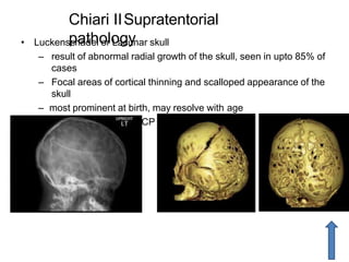 Chiari IISupratentorial
pathology• Luckenschadel or Lacunar skull
– result of abnormal radial growth of the skull, seen in upto 85% of
cases
– Focal areas of cortical thinning and scalloped appearance of the
skull
– most prominent at birth, may resolve with age
– not a result of raised ICP and hydrocephalus
 