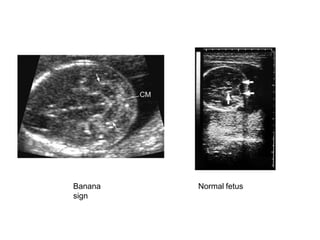 Banana
sign
Normal fetus
 