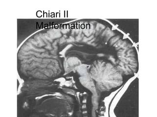 Chiari II
Malformation
 