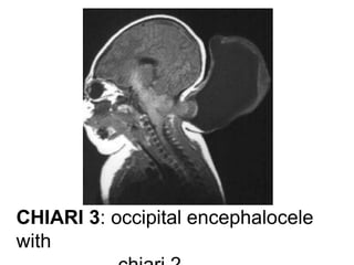 CHIARI 3: occipital encephalocele
with
 