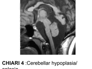 CHIARI 4 :Cerebellar hypoplasia/
 