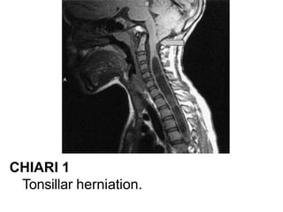 CHIARI 1
Tonsillar herniation.
 