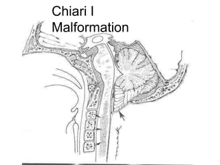 Chiari I
Malformation
 