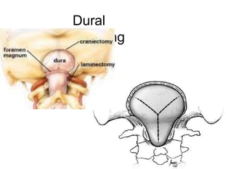Dural
Opening
 