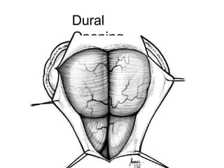 Dural
Opening
 
