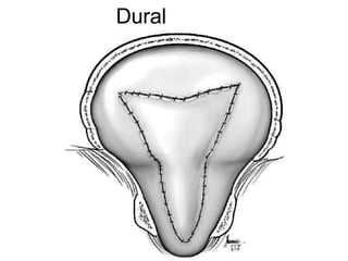 Dural
Closure
 