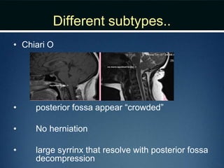 Different subtypes..
• Chiari O
• posterior fossa appear “crowded”
• No herniation
• large syrrinx that resolve with posterior fossa
decompression
 