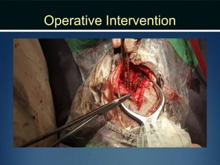 Operative Intervention
 