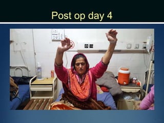 Post op day 4
 