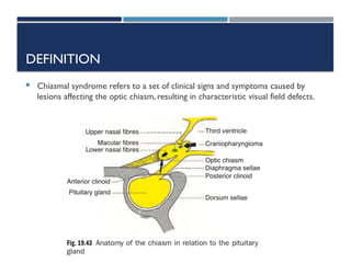Chiasmal Syndrome RAFIDAH edited version | PPTX