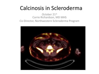 Calcinosis in Scleroderma
October 21st
Carrie Richardson, MD MHS
Co-Director, Northwestern Scleroderma Program
 