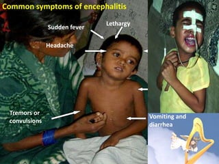 Lethargy
Sudden fever
Vomiting and
diarrhea
Tremors or
convulsions
Headache Change in
consciousness
Irritability or
restlessness
Common symptoms of encephalitis
 