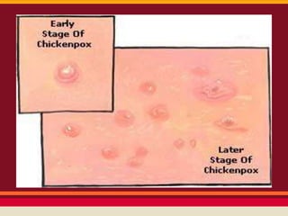 Chickenpox | PPTX