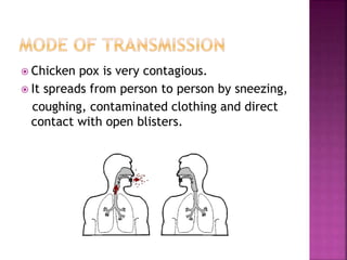Chicken pox | PPTX