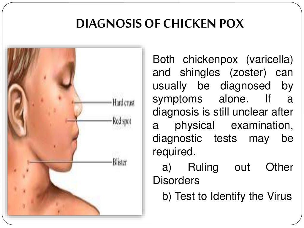 Chicken pox