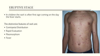 Chickenpox | PPTX