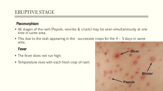 chicken pox medical term