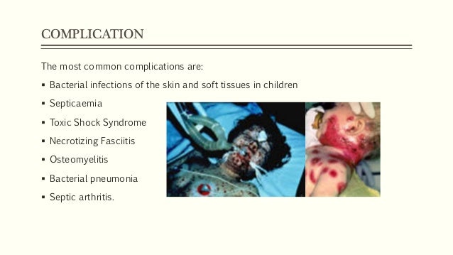 Chickenpox Chickenpox