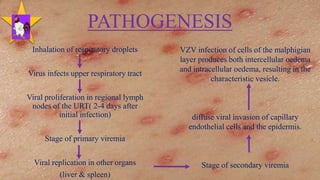 PATHOGENESIS
Inhalation of respiratory droplets
Virus infects upper respiratory tract
Viral proliferation in regional lymph
nodes of the URT( 2-4 days after
initial infection)
Stage of primary viremia
Viral replication in other organs
(liver & spleen)
VZV infection of cells of the malphigian
layer produces both intercellular oedema
and intracellular oedema, resulting in the
characteristic vesicle.
diffuse viral invasion of capillary
endothelial cells and the epidermis.
Stage of secondary viremia
19
 