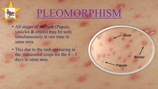 Chickenpox | PPTX