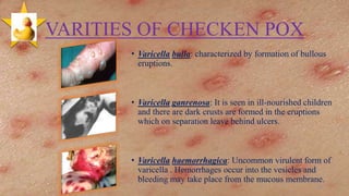 VARITIES OF CHECKEN POX
• Varicella bulla: characterized by formation of bullous
eruptions.
• Varicella ganrenosa: It is seen in ill-nourished children
and there are dark crusts are formed in the eruptions
which on separation leave behind ulcers.
• Varicella haemorrhagica: Uncommon virulent form of
varicella . Hemorrhages occur into the vesicles and
bleeding may take place from the mucous membrane.
30
 