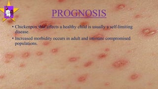 Chickenpox | PPTX