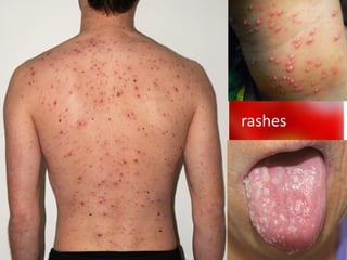 Chicken pox | PDF