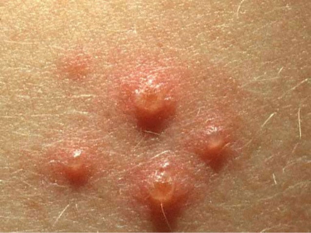 chicken pox