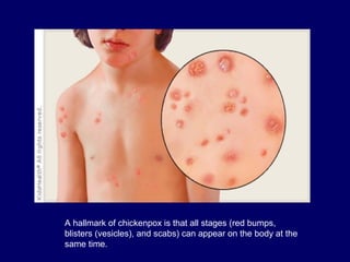 A hallmark of chickenpox is that all stages (red bumps,
blisters (vesicles), and scabs) can appear on the body at the
same time.