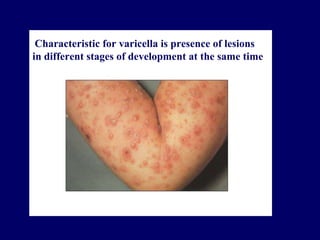 Characteristic for varicella is presence of lesions
in different stages of development at the same time
