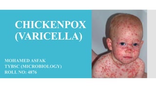 CHICKENPOX
(VARICELLA)
MOHAMED ASFAK
TYBSC (MICROBIOLOGY)
ROLL NO: 4876
 