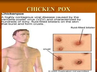 CHICKEN POX
 