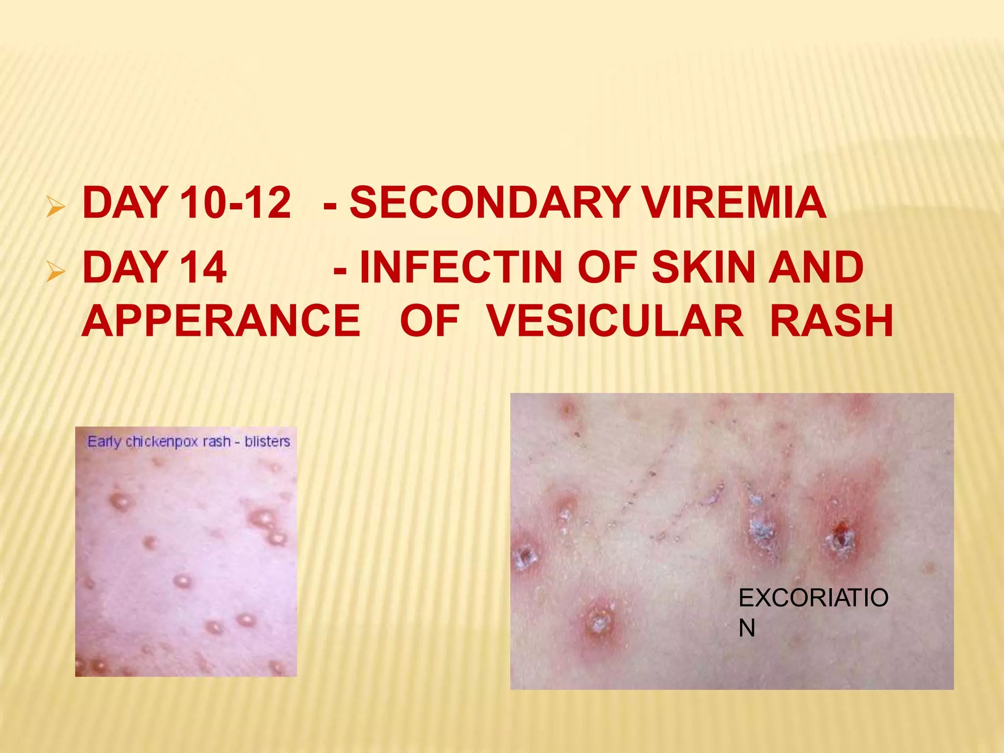 Chickenpox | PPTX