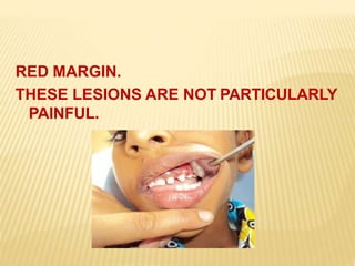 RED MARGIN.
THESE LESIONS ARE NOT PARTICULARLY
PAINFUL.
 