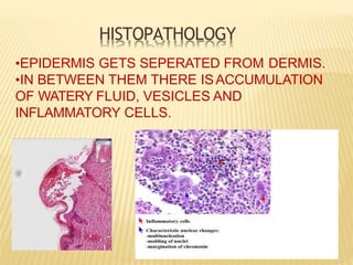 HISTOPATHOLOGY
•EPIDERMIS GETS SEPERATED FROM DERMIS.
•IN BETWEEN THEM THERE ISACCUMULATION
OF WATERY FLUID, VESICLES AND
INFLAMMATORY CELLS.
 