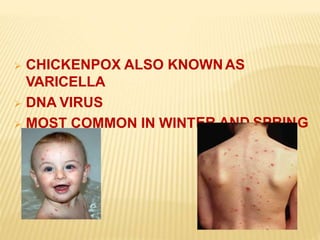  CHICKENPOX ALSO KNOWNAS
VARICELLA
 DNA VIRUS
 MOST COMMON IN WINT GER AND SPRIN
 