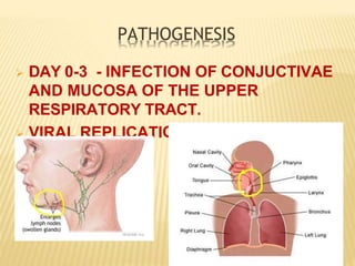 PATHOGENESIS
 DAY 0-3 - INFECTION OF CONJUCTIVAE
AND MUCOSA OF THE UPPER
RESPIRATORY TRACT.
 VIRAL REPLICATION IN REGIONAL
LYMPH NODES
 