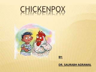 CHICKENPOX
BY:
DR. SAURABH AGRAWAL
 