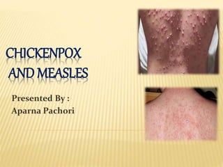 CHICKENPOX
AND MEASLES
Presented By :
Aparna Pachori
 