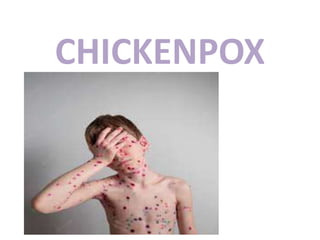 CHICKENPOX
 