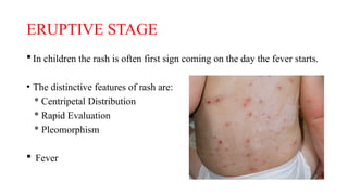 CHICKENPOX as in according to modern science.pptx