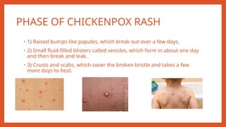 CHICKENPOXmauryasonal...............pptx