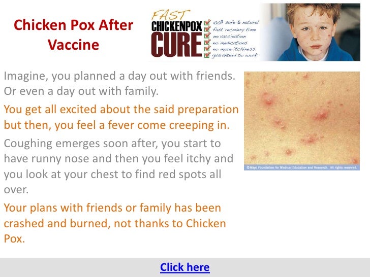 a report on the history of chicken pox Varicella zoster virus (vzv) is a neurotropic α-herpesvirus that causes chickenpox and establishes life-long latency in the cranial nerve and dorsal root ganglia of the host to date, vzv is the only virus consistently reported to have an inverse association with glioma the glioma international. a report on the history of chicken pox Varicella zoster virus (vzv) is a neurotropic α-herpesvirus that causes chickenpox and establishes life-long latency in the cranial nerve and dorsal root ganglia of the host to date, vzv is the only virus consistently reported to have an inverse association with glioma the glioma international.