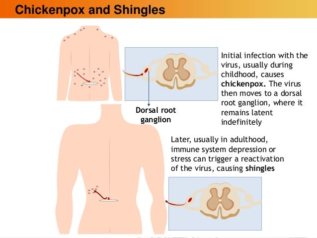 the cause symptoms and treatments for chickenpox and shingles