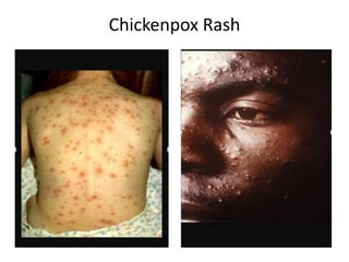 Nursing care for patient with CHICKEN POX [Autosaved].pptx