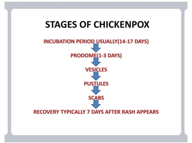 CHICKEN POX diagnosis and management ppt | PPTX | Infectious Diseases ...