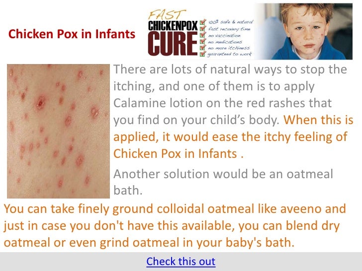Chicken Pox in Infants
